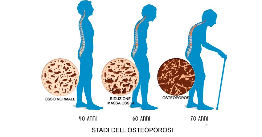 Il silicio per migliorare l’osteoporosi