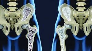 Osteoporosi e il danno&nbsp;mitocondriale